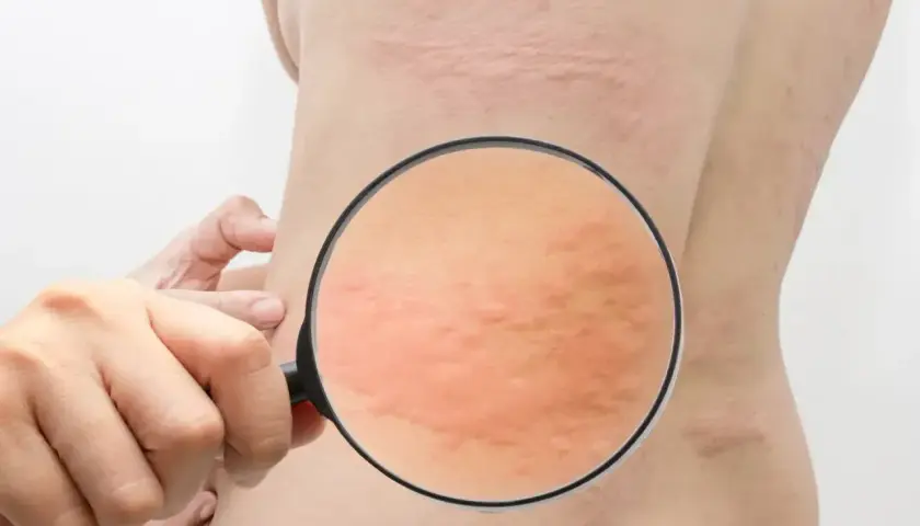 Skóra z zaczerwienieniem i wysypką, powiększona lupą. Objawy mogą wskazywać na uczulenie na spermę.