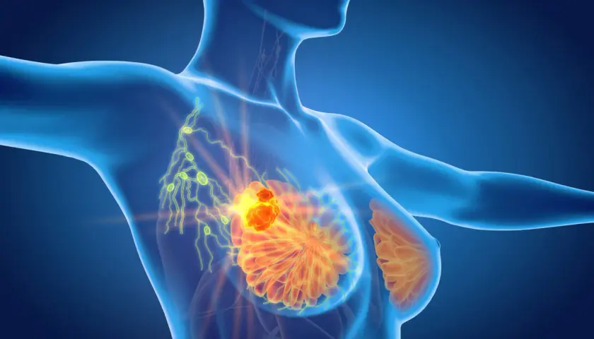 Anatomical rendering showing a tumor in the breast and enlarged lymph nodes, indicating limfadenopatia.