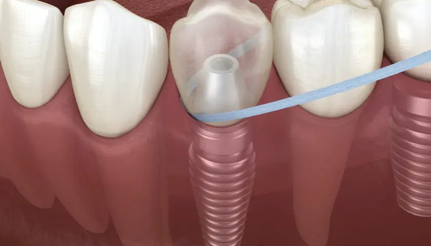 Filo interdentale che pulisce attorno a un impianto dentale. È importante prendersi cura dell'igiene orale, anche se si possono lavare i denti prima di un intervento.