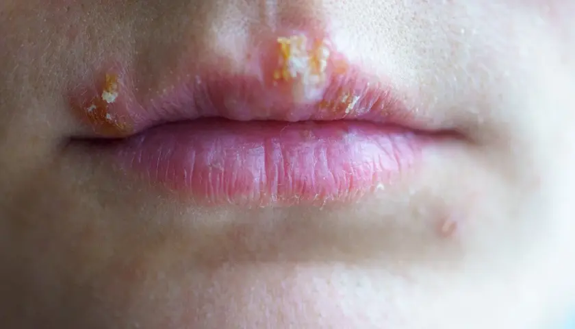 Labios con ampollas y costras, indicativo de herpes labial contagio.