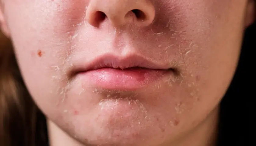 Peau très sèche, craquelée et squameuse autour de la bouche et du nez. Peut-être une réaction à un produit ou un manque d'hydratation.