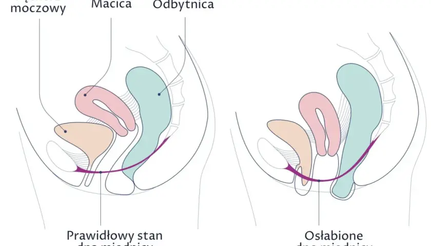Ilustracja porównuje prawidłowy stan dna miednicy z osłabionym, pokazując, jak wypadanie macicy może wpływać na narządy.