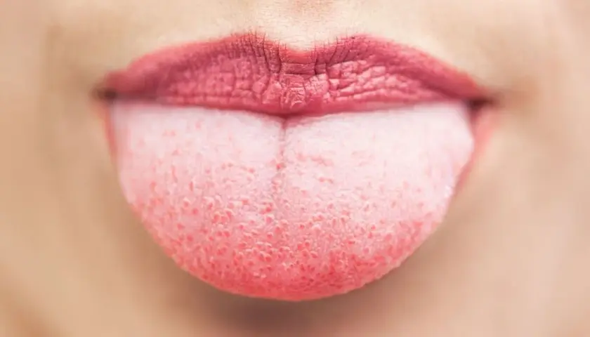 Lingua rosa con puntini rossi, forse un segno di lingua streptococco. Labbra con rossetto scuro.