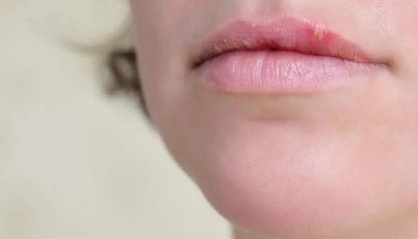 Primo piano delle labbra con una vescicola di herpes che indica perche esce herpes.