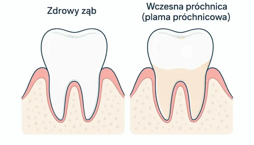 Porównanie zdrowego zęba z zębem z wczesną próchnicą. Widać, że próchnica tworzy na zębie nieestetyczną plamę, która może przerodzić się w dziurę.
