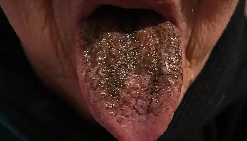 Lingua nera con papille ispessite e macchie scure, come se fosse coperta di terra.