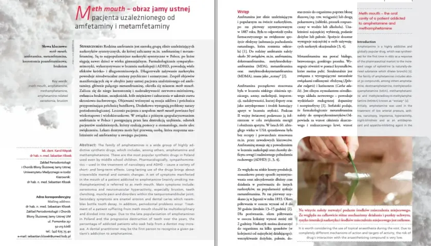 Amfetamina a zęby: Jak rozpoznać i leczyć "meth mouth"?