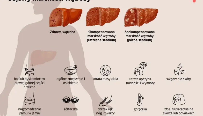 Objawy marskości wątroby: ból brzucha, zmęczenie, utrata masy ciała, żółtaczka, obrzęki, gorączka, swędzenie skóry.
