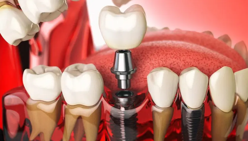 Illustrazione di un impianto perno dente, con la vite inserita nell'osso e la corona in attesa di essere posizionata.