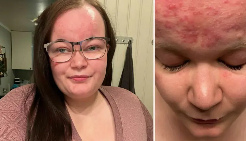 Kvinna med glasögon visar upp sin hud med rodnad och utslag, troligen mild rosacea.