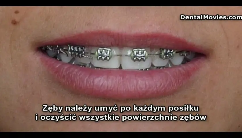 Ile trwa zakładanie aparatu i czy boli? Przewodnik ortodonty