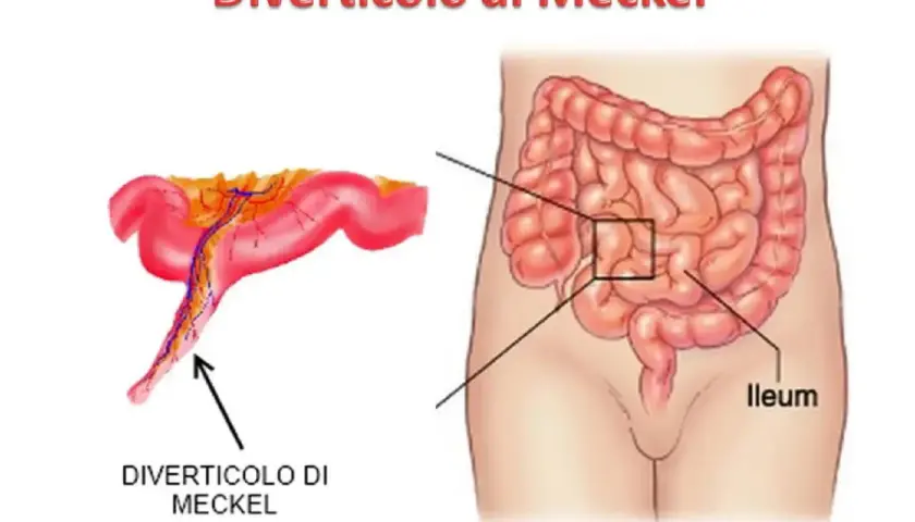 Illustrazione anatomica che mostra un diverticolo di Meckel, una piccola sacca nell'intestino tenue.