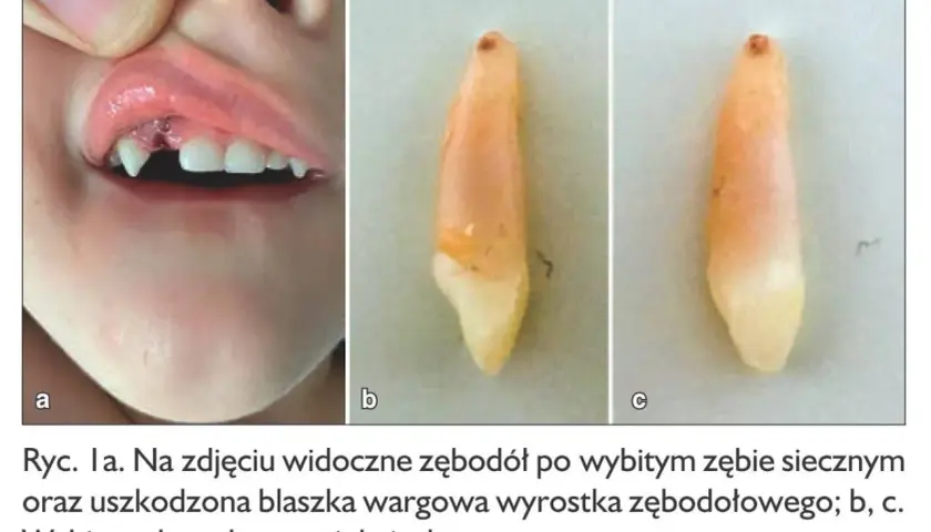 Wypadanie zębów mlecznych u 5 latka: widoczny zębodół po wybitym zębie i uszkodzona warga. Obok wybity ząb w dwóch ujęciach.