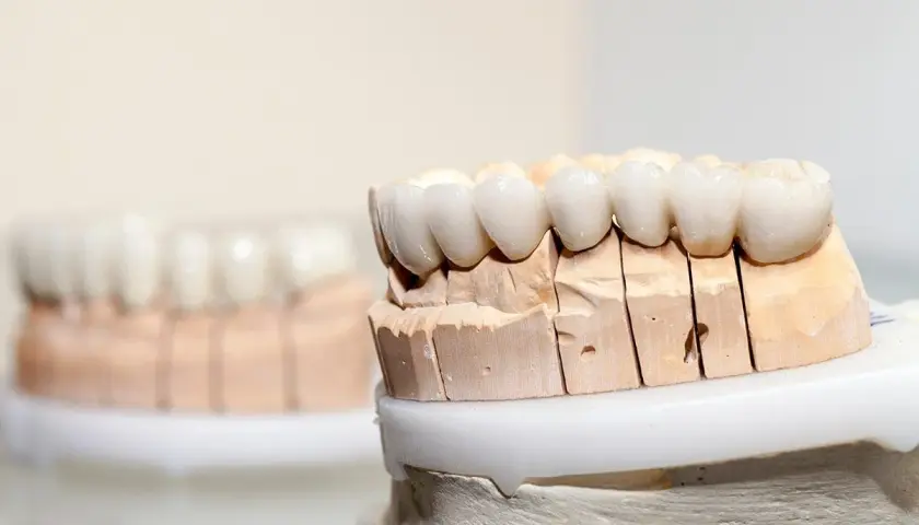Modelli di denti in porcellana su un supporto in gesso, pronti per essere applicati.
