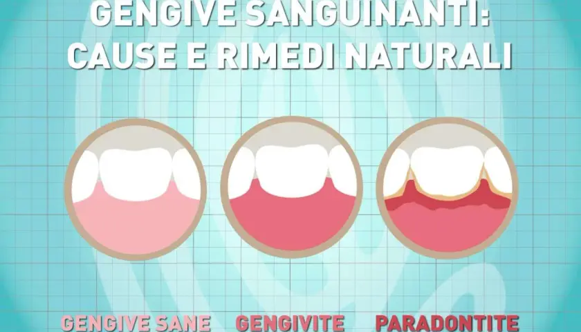 Illustrazione mostra gengive sane, gengivite e parodontite, con la progressione che porta a gengive sanguinanti.