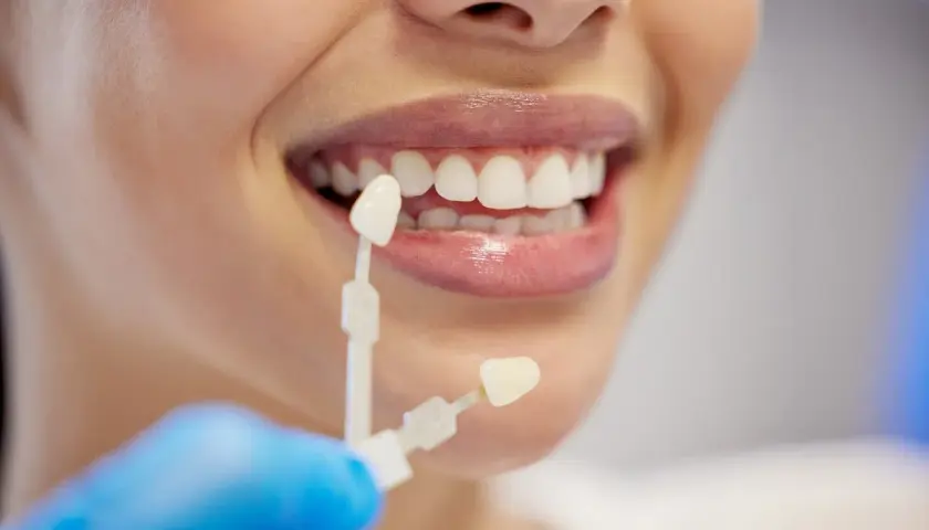 Dobieranie koloru licówek do naturalnych zębów. Na ile zębów zakłada się licówki? Decyzja należy do pacjenta i dentysty.