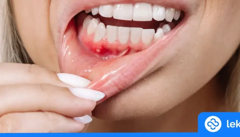 Ropa w dziąśle: Jak sobie pomóc i kiedy pilnie do dentysty?