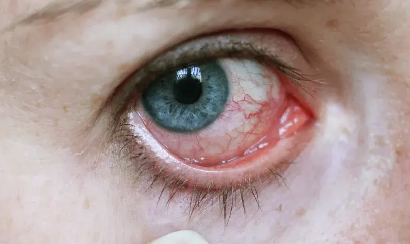 Fibromyalgie Symptome Augen: Unerwartete Beschwerden und Lösungen