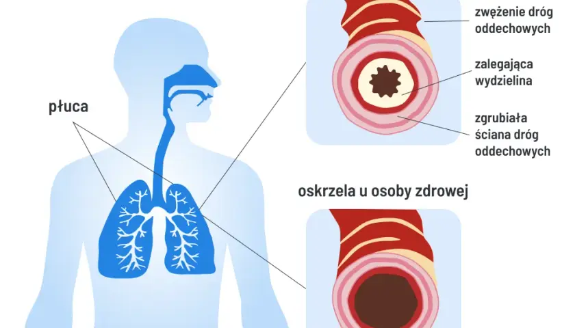 Czy POChP kwalifikuje do renty? Sprawdź, co musisz wiedzieć