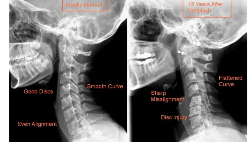 Skręcenie kręgosłupa szyjnego: niebagatelne objawy neurologiczne, które musisz znać