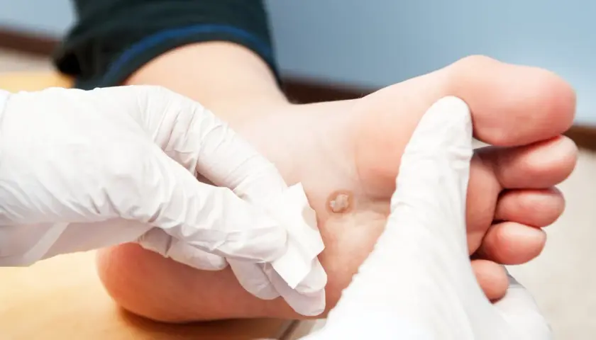 Mani guantate applicano un impacco su una verruca plantare, un rimedio della nonna per le verruche.