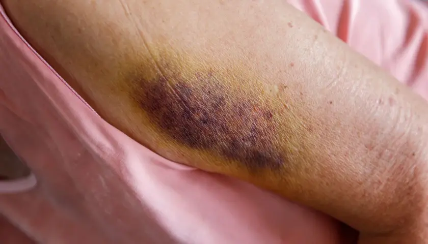 Gros hématome violacé sur un bras, signe d'une jambe en sang suite à un choc. La peau est meurtrie et jaunie par endroits.