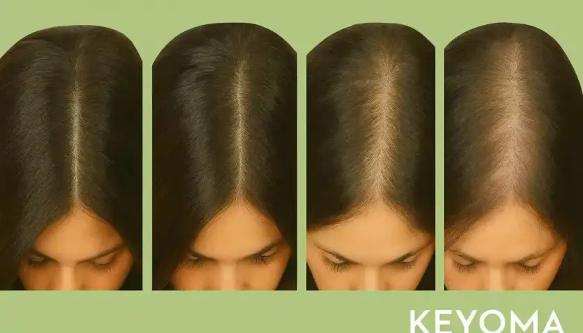 Cuatro imágenes muestran cómo crece el pelo, desde una línea capilar más densa hasta una más fina, ilustrando el proceso.