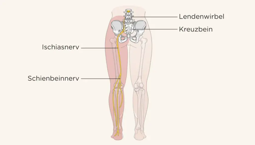 Der Ischiasnerv verläuft vom Kreuzbein durch das Bein bis zum Schienbein.