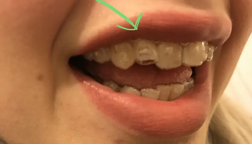 Flecha verde señala un diente donde el **invisalign no encaja**. Se ven los alineadores transparentes en los dientes.
