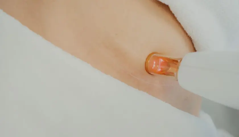Närbild på hud med laserbehandling för bristningar. En vit apparat med orange spets närmar sig huden.