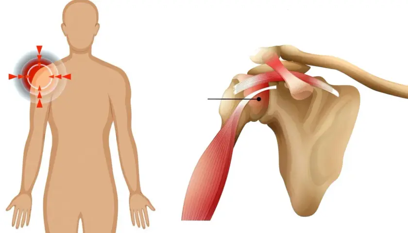 Ilustracja pokazuje ból lewego ramienia i barku, z zaznaczonym obszarem zapalenia na schemacie ciała i zbliżeniem na staw barkowy.