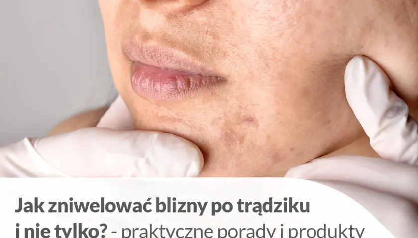 Jak usunąć blizny domowym sposobem? Zbliżenie na skórę z widocznymi śladami po trądziku, sugerujące poszukiwanie rozwiązań.