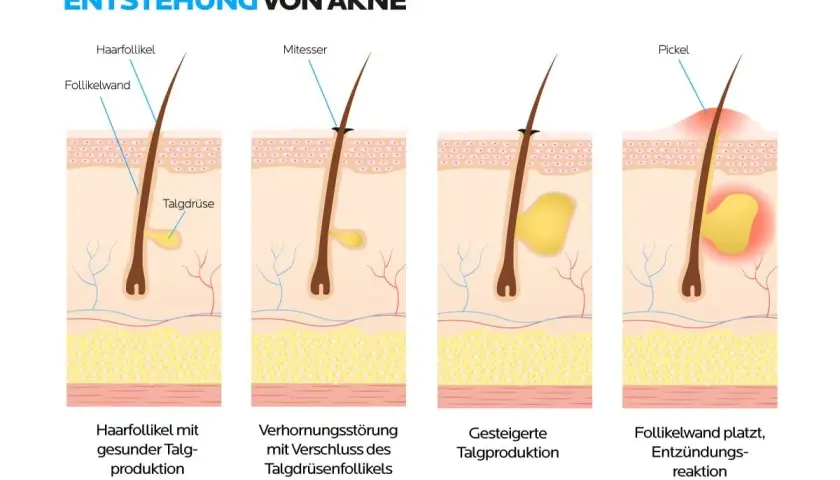 Illustration zeigt, wie entstehen Mitesser: Verhornungsstörung und erhöhte Talgproduktion führen zu verstopften Follikeln, die sich entzünden.