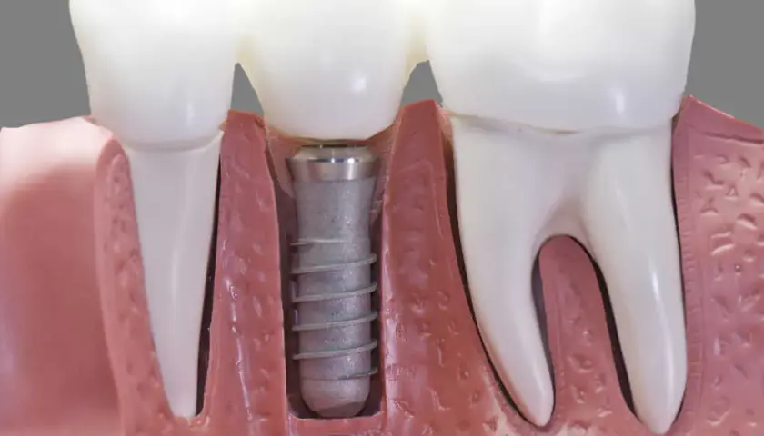 Czy po wszczepieniu implantu zęba można iść do pracy bez obaw?