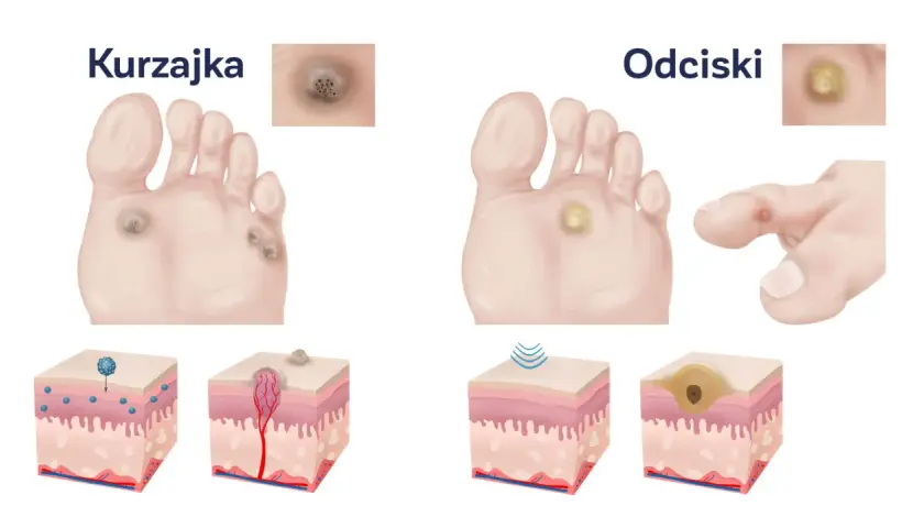 Ilustracja porównuje kurzajki i odciski na stopach. Odcisk na stopie po angielsku to "corn".