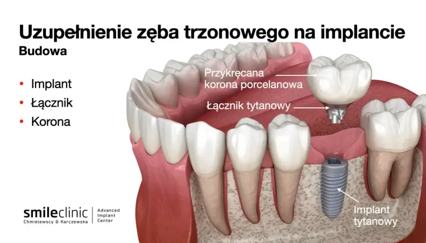 Budowa zęba trzonowego na implancie: implant tytanowy, łącznik i korona porcelanowa.