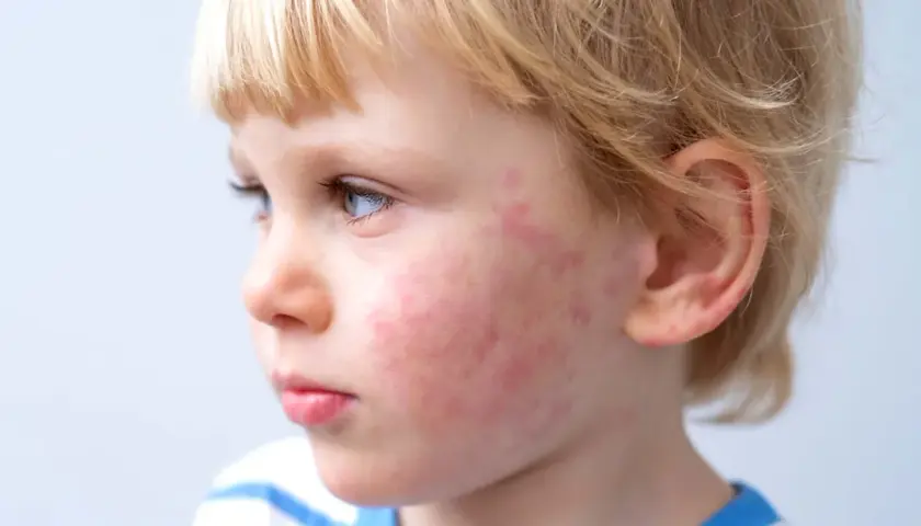 Primo piano del viso di un bambino con macchie rosse sulle guance, possibili macchie allergie alimentari bambini.