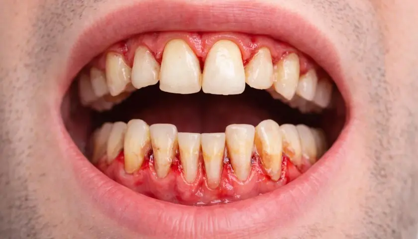 Encías inflamadas y enrojecidas alrededor de los dientes, indicativo de periodontitis leve.