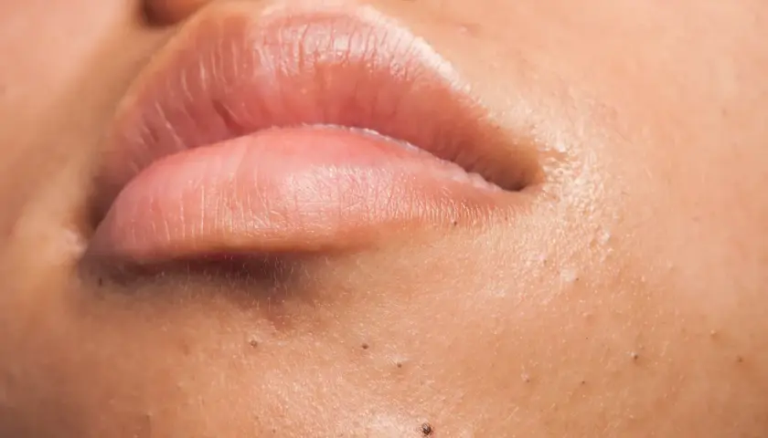 Gros plan sur des lèvres et une peau présentant des points noirs, un aperçu de comment enlever les comédons pour une peau nette.