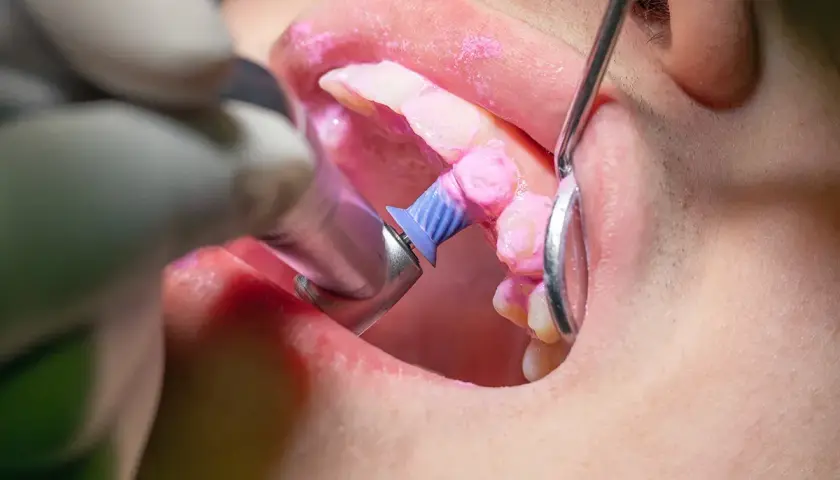 Dettaglio di un trattamento di igiene orale: il dentista usa uno strumento rotante per pulire i denti, coperti da una pasta rosa.