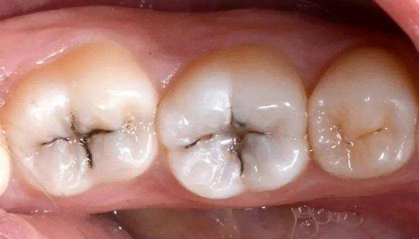 Denti con piccole carie scure nelle fessure.