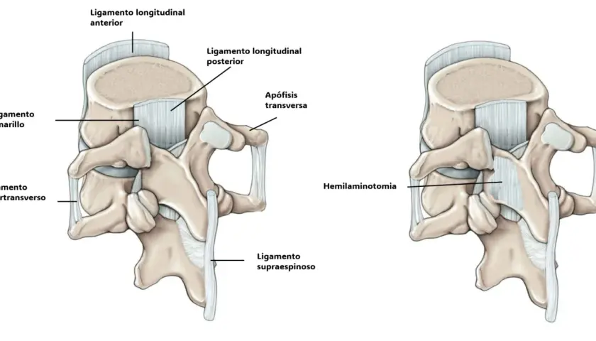 Ilustración de la anatomía lumbar antes y después de una hemilaminectomía, mostrando ligamentos y apófisis.