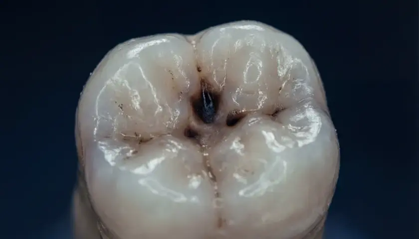 Dente con una cavità scura al centro, un chiaro segno di carie. I sintomi iniziali possono essere sottili, ma questa immagine mostra la progressione.