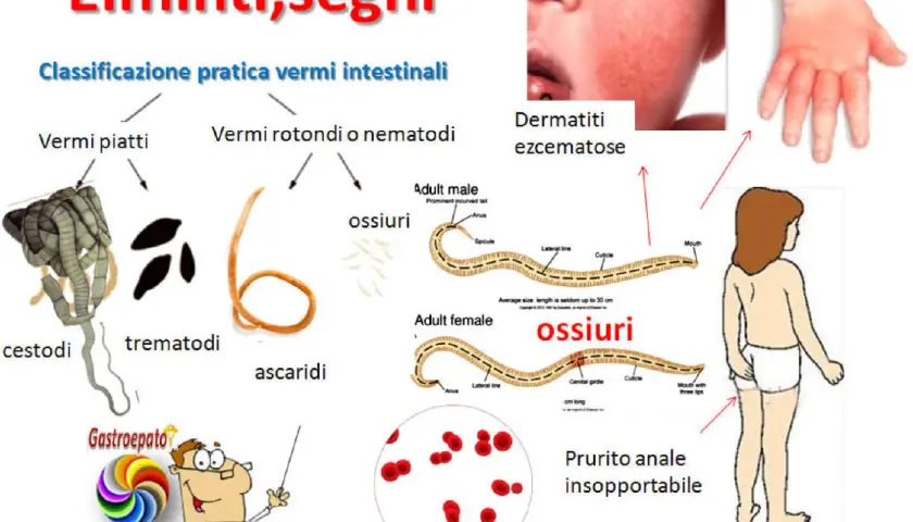 Immagine illustra vermi intestinali e i loro sintomi: dermatiti, prurito anale, anemia.