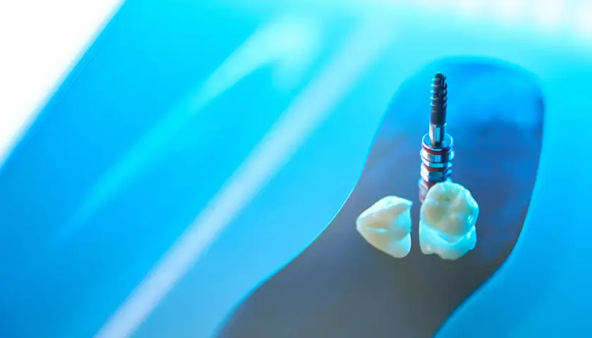 Impianti in zirconia e corone dentali, un futuro di sorrisi perfetti.