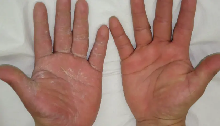 Manos con piel seca y escamosa en la izquierda, que podría indicar que significa cuando te pica la mano derecha. La mano derecha se ve sana.