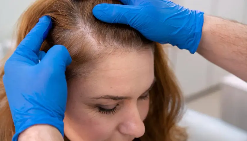 Manos enguantadas revisan las entradas pelo mujer, evaluando la línea del cabello.