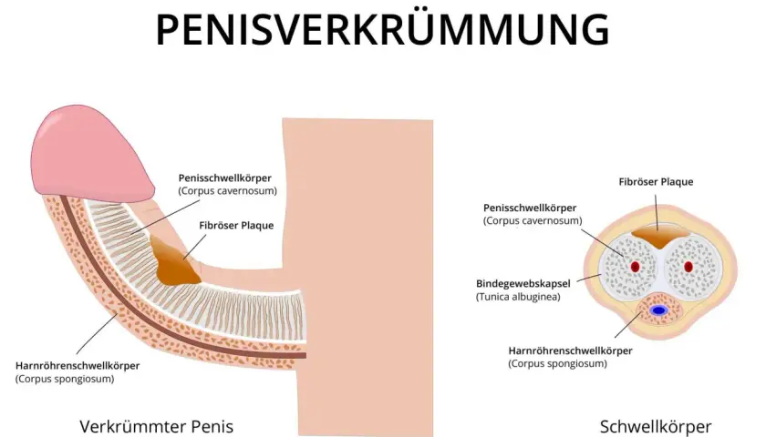 Illustration zeigt einen verkrümmten Penis mit fibrosen Plaques, die den Penisschwellkörper beeinträchtigen. Ein "buried penis" ist hier nicht dargestellt.