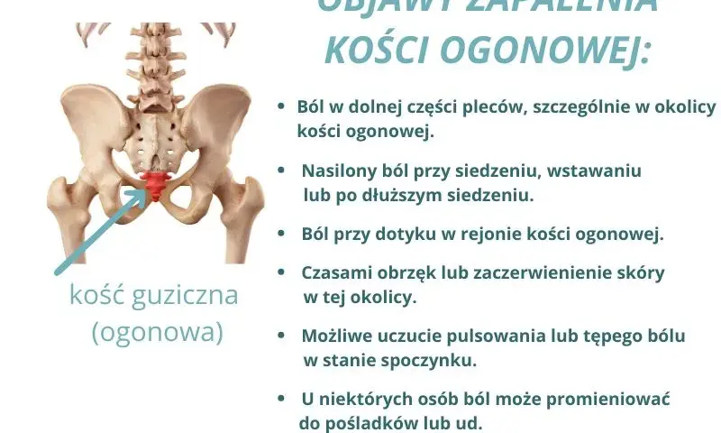 Ból kości ogonowej: Przyczyny, objawy i skuteczne leczenie