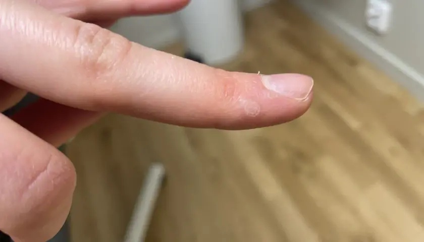 Närbild på en finger med en liten vårta på handflatan. Vårtan har en ringformad struktur.